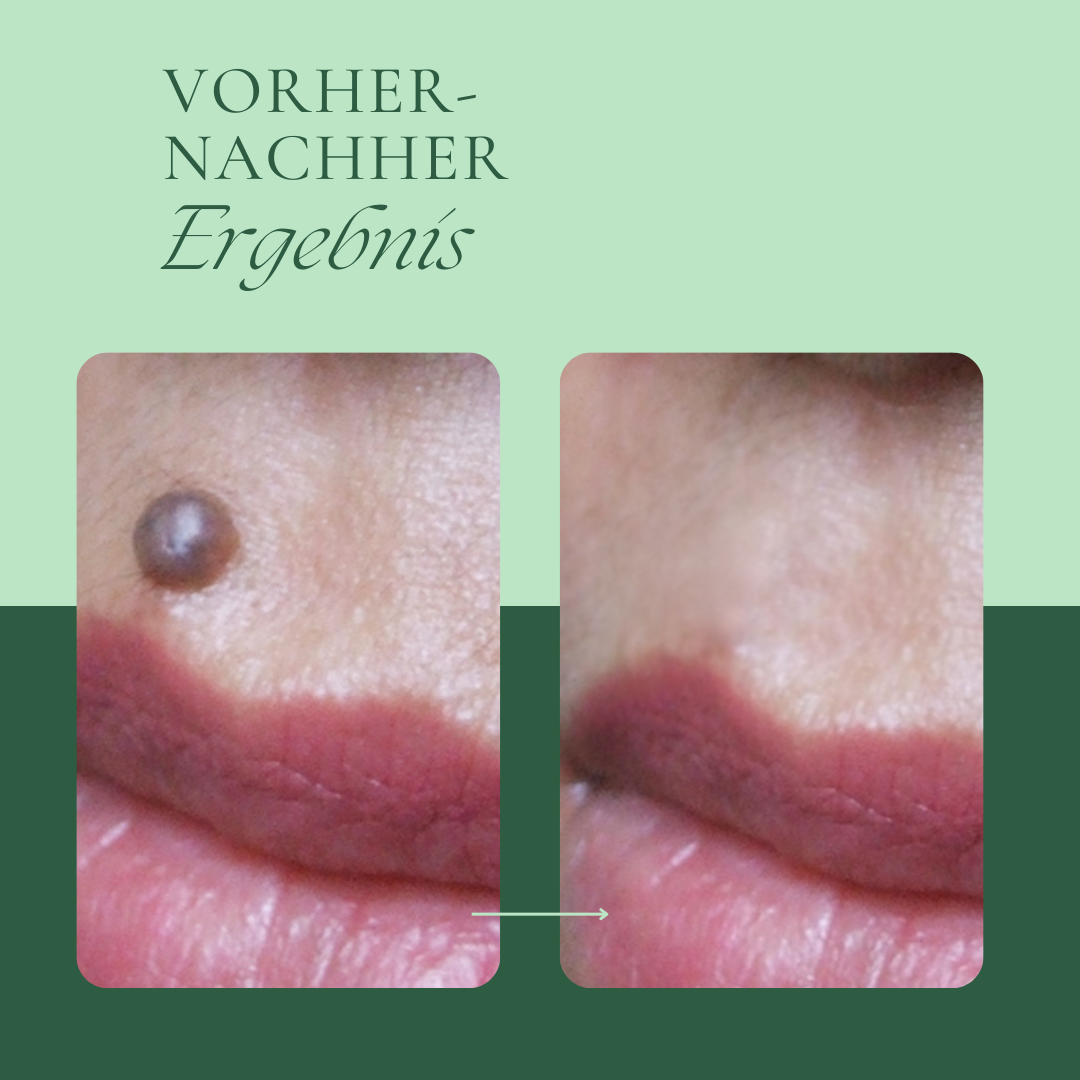 Creamole - Pflanzliche Creme zur Entfernung von Muttermalen, Leberflecken & Warzen