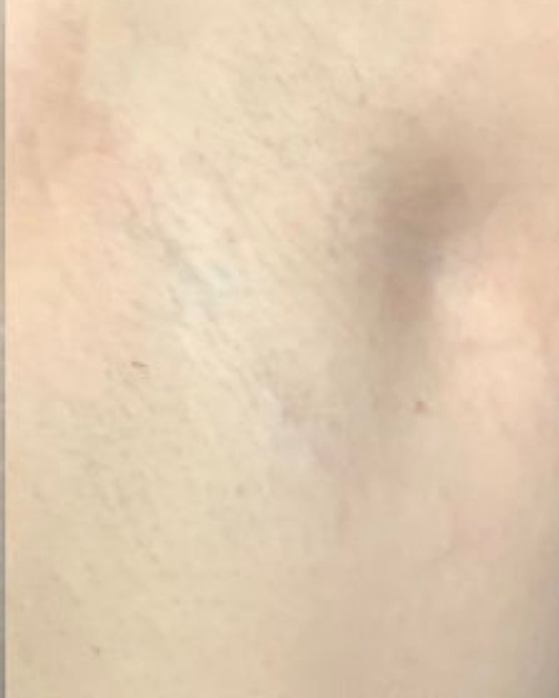 Nachher – Hals/Dekolleté