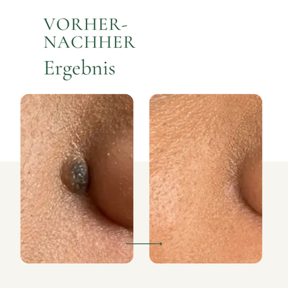 Creamole - 100% natürliche Creme zur Entfernung von Muttermalen, Leberflecken & Warzen