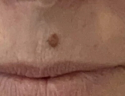 Vorher – Über Oberlippe